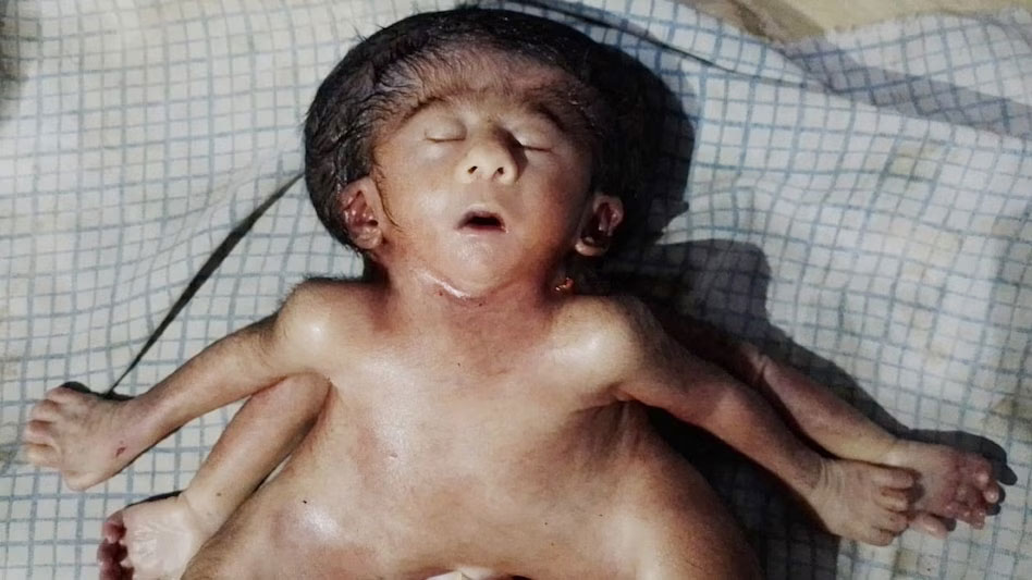 Surprising Baby Girl Born in Bihar Conjoined Twins