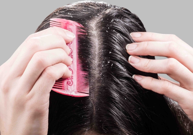 Say Goodbye to Dandruff: Steps for Healthy, Shiny Hair