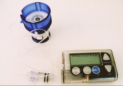 Insulin pump introduced for type-a diabetes 