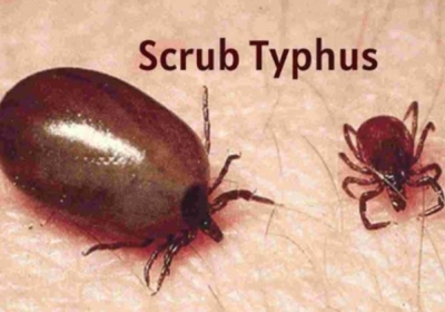 13 patients admitted in IGMC, scrub typhus knocks as soon as it rains