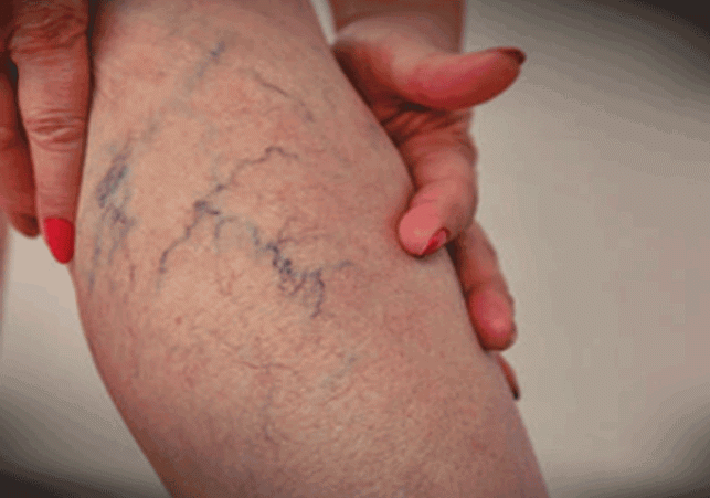 25 percent Indians suffer from varicose veins